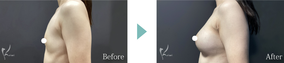 私の得意な施術 豊胸術（シリコンバッグ）