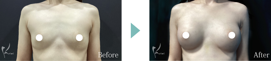 私の得意な施術 豊胸術（シリコンバッグ）