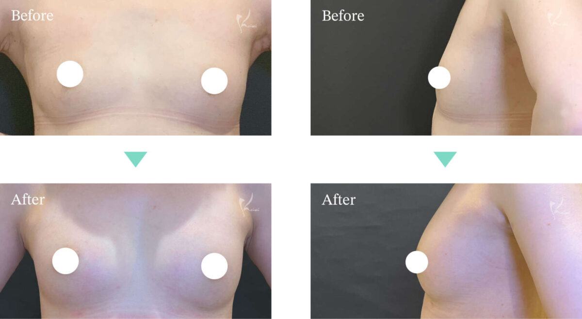 ヒアルロン酸による豊胸術症例写真