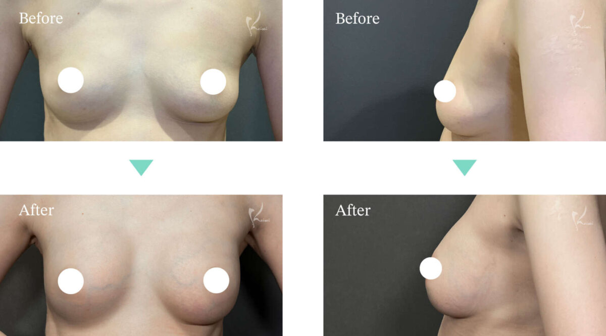 シリコンバッグによる豊胸術症例写真