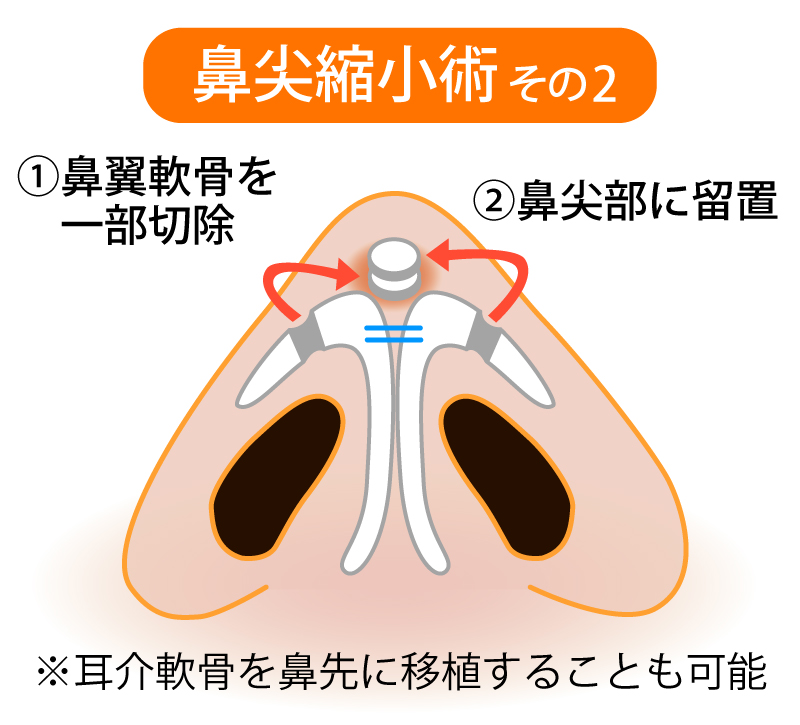 鼻尖縮小術２イメージ