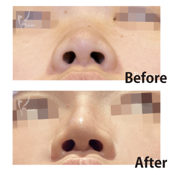 だんご鼻スッキリ。鼻尖形成術　サムネイル