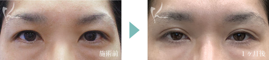 二重全切開法＆眼瞼下垂の症例紹介
