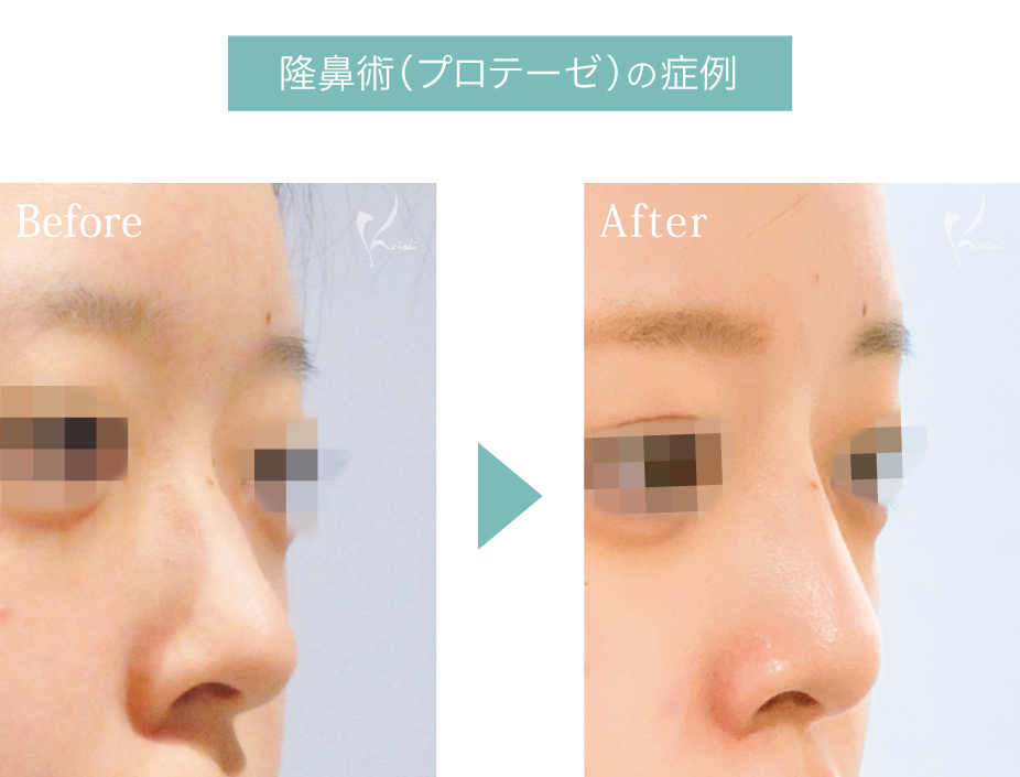 隆鼻術（プロテーゼ）の手術の症例写真
