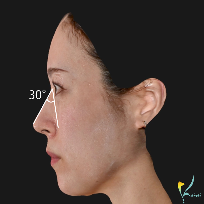 鼻背と付け根の角度が30°