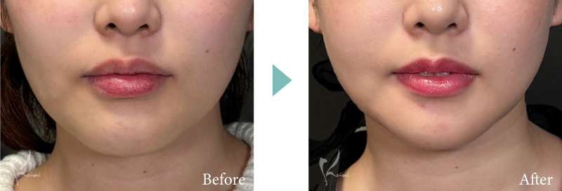 術前・術後　正面下顔面の症例（顎の長さ・四角さの変化が分かるもの）