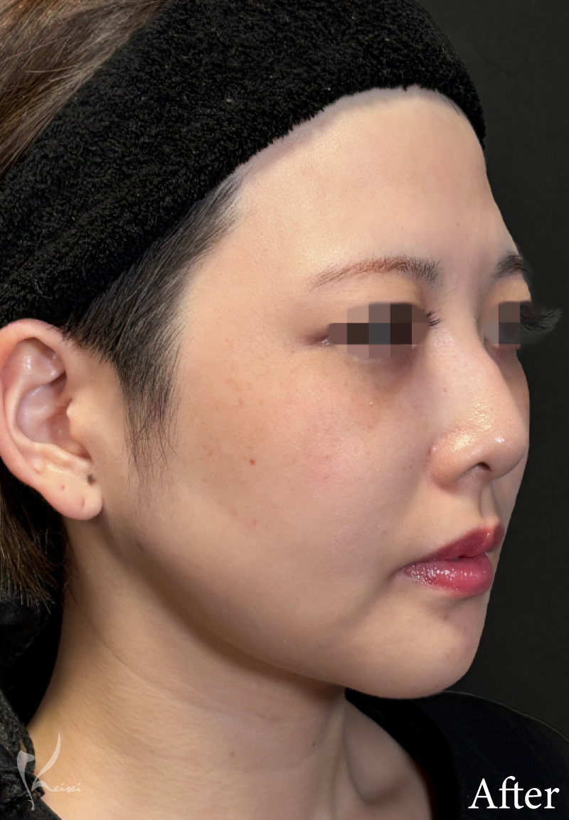 術後　斜めの症例