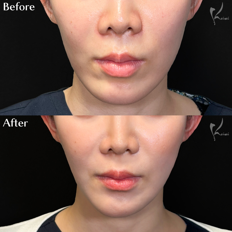 Vライン形成症例写真・正面