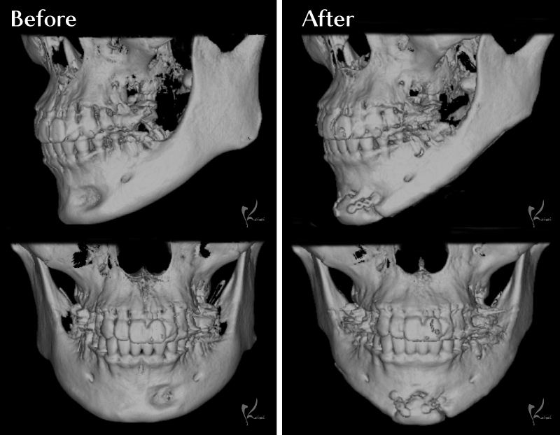 Vライン形成症例 3DCT比較画像