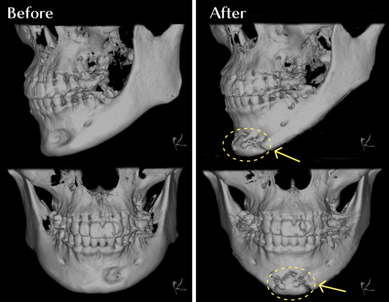 Vライン形成症例 3DCT比較画像 2