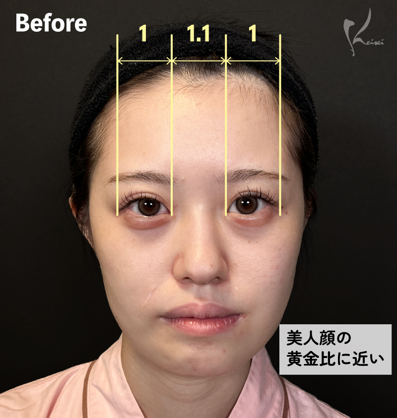 Before正面写真・美人顔の黄金比に近い