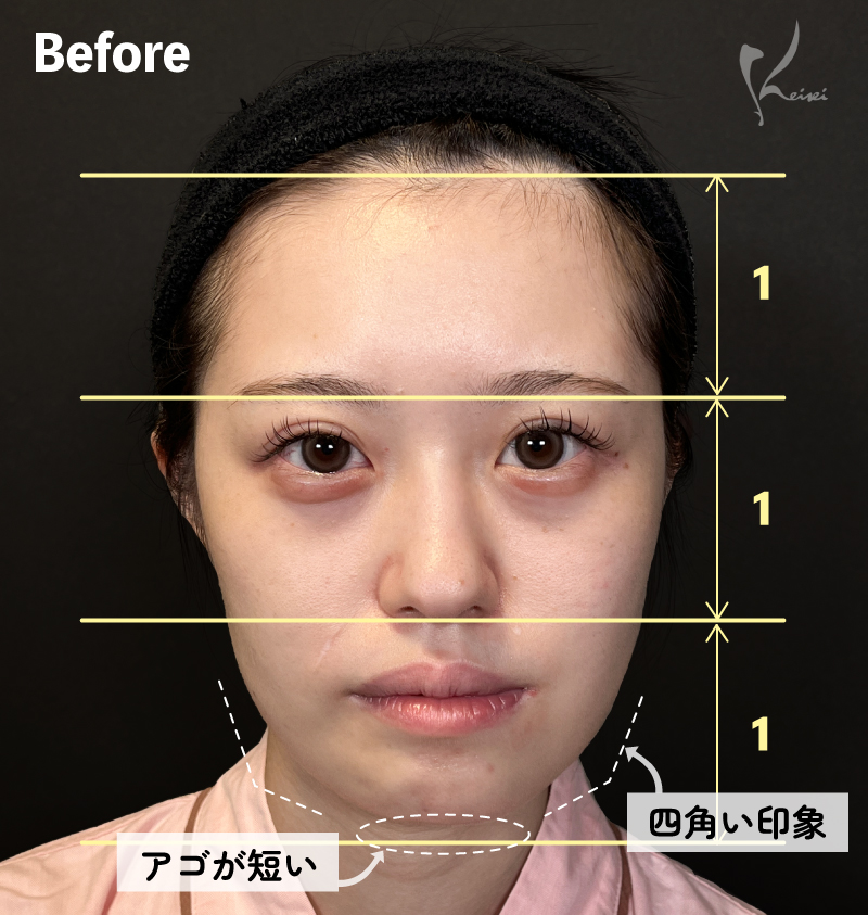 Before正面写真・四角い印象・アゴが短い