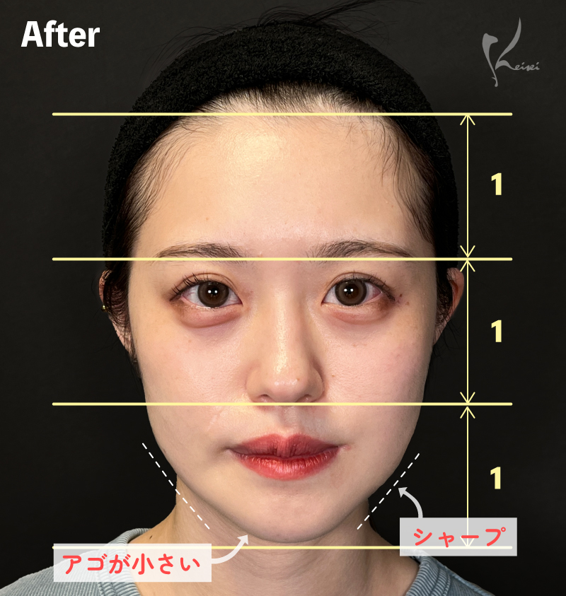 After写真（正面）