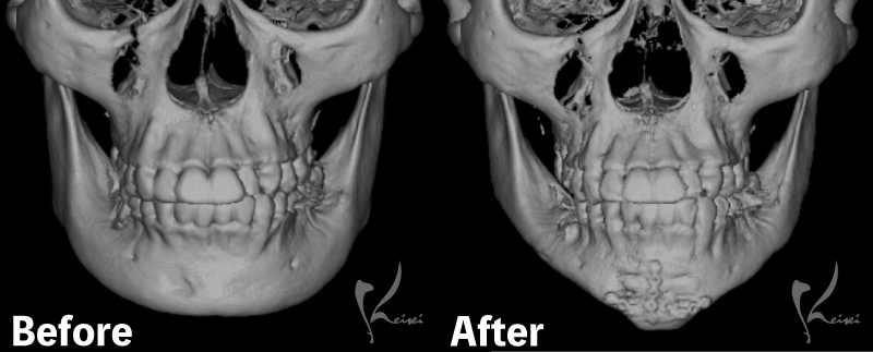 before・After写真（骨・正面）