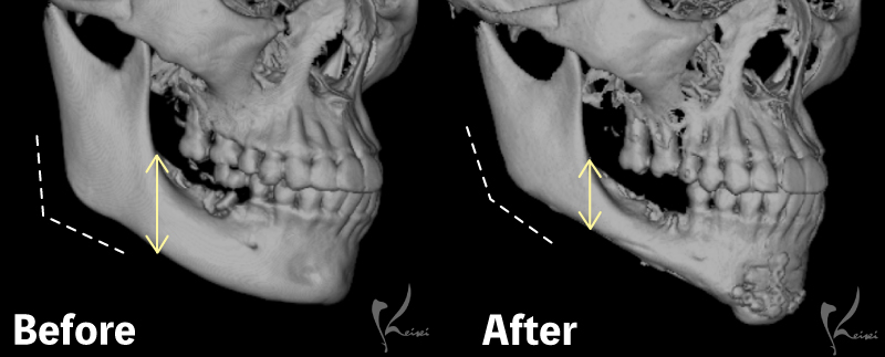 before・After写真（骨・斜め面）