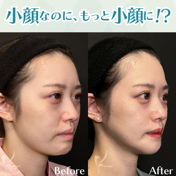 骨切りVライン形成症例紹介　小顔なのにもっと小顔に!?サムネイル