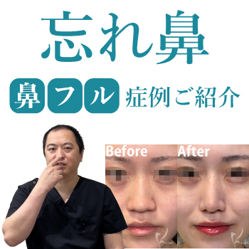 忘れ鼻　鼻フル症例ご紹介サムネイル
