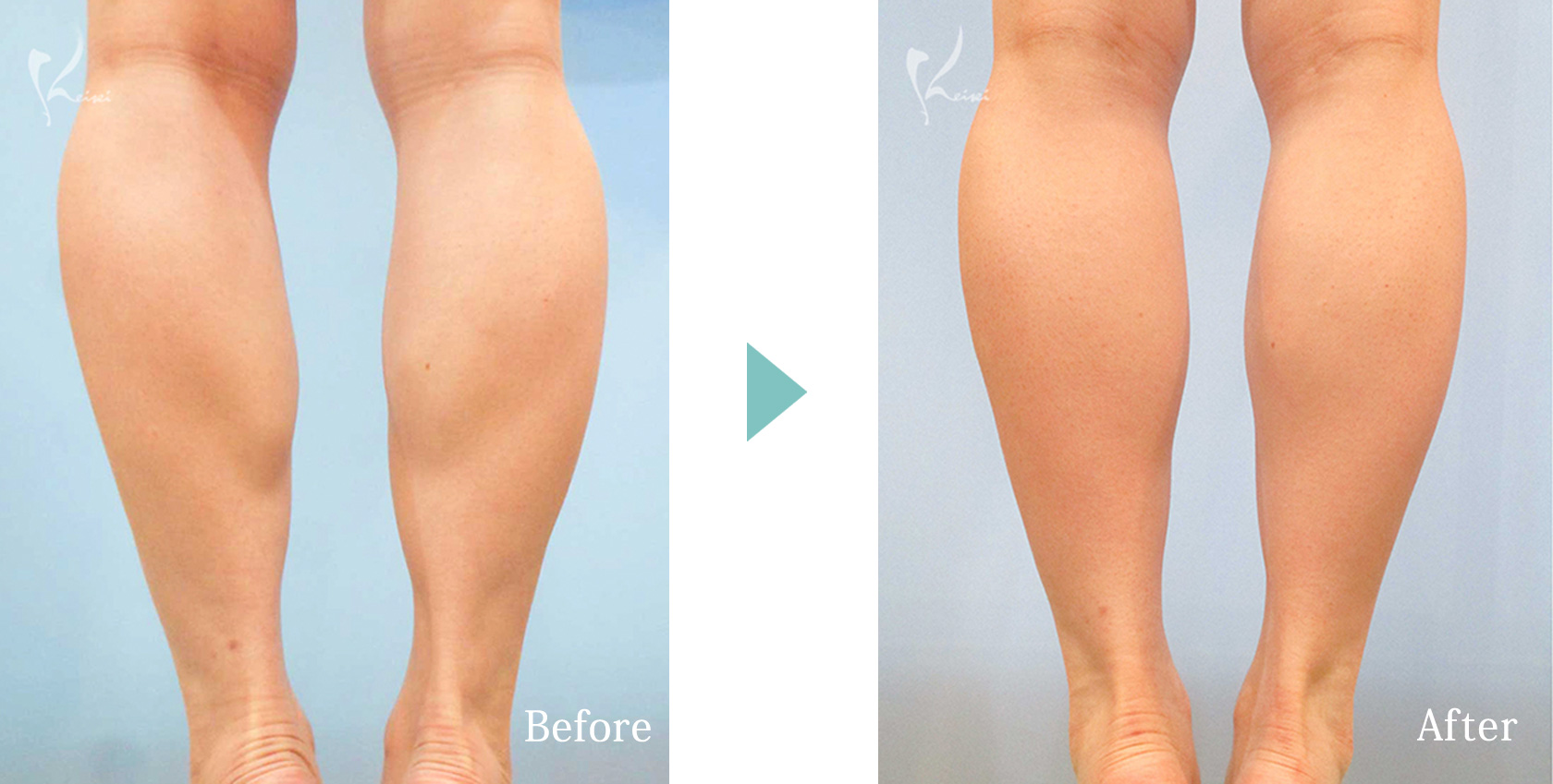 ふくらはぎのカーフメイク（TCR）の症例写真