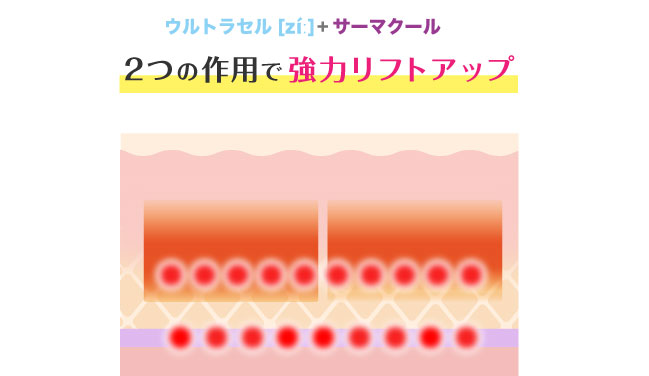 ウルトラセル[zíː]とサーマクールを併用した時の照射範囲