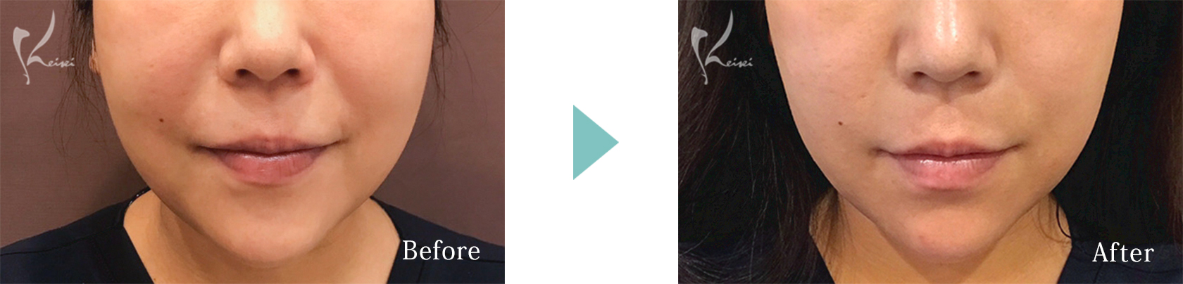 医療ハイフ（HIFU）ウルトラセル[zíː]