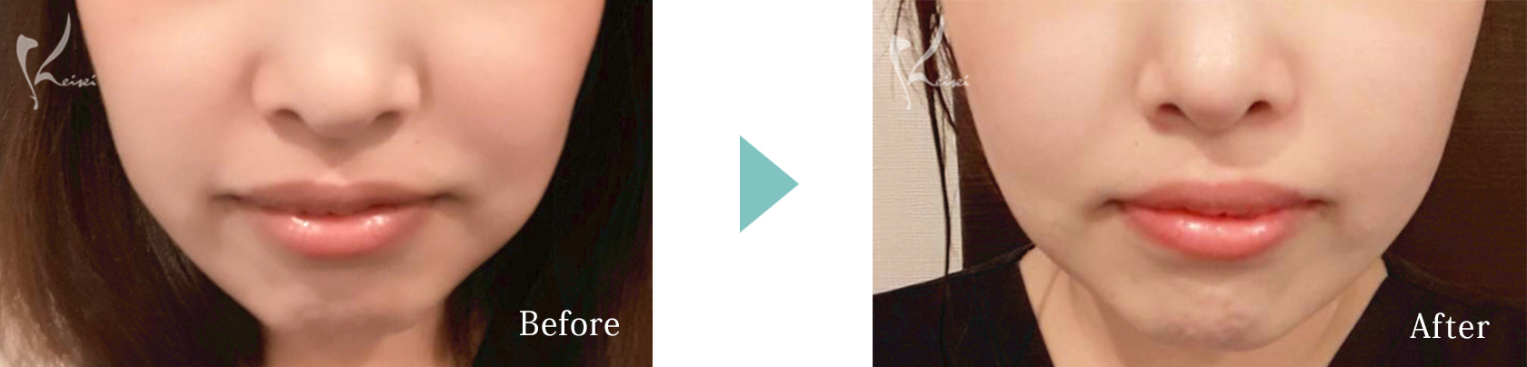 医療ハイフ（HIFU）ウルトラセル[zíː]