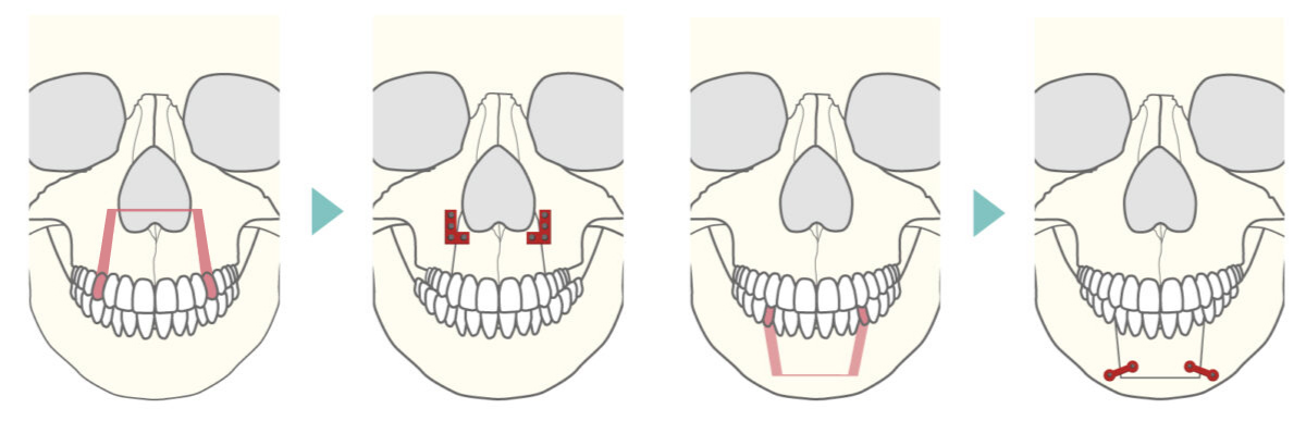 上下顎分節骨切り術式の正面からのイメージ