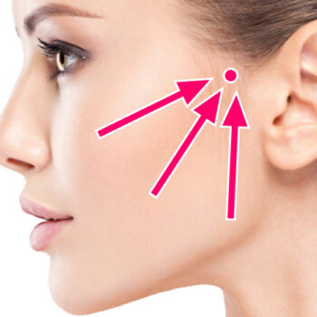 vovリフト リフトアップ 糸リフト スレッドリフト エイジングケア アンチエイジング