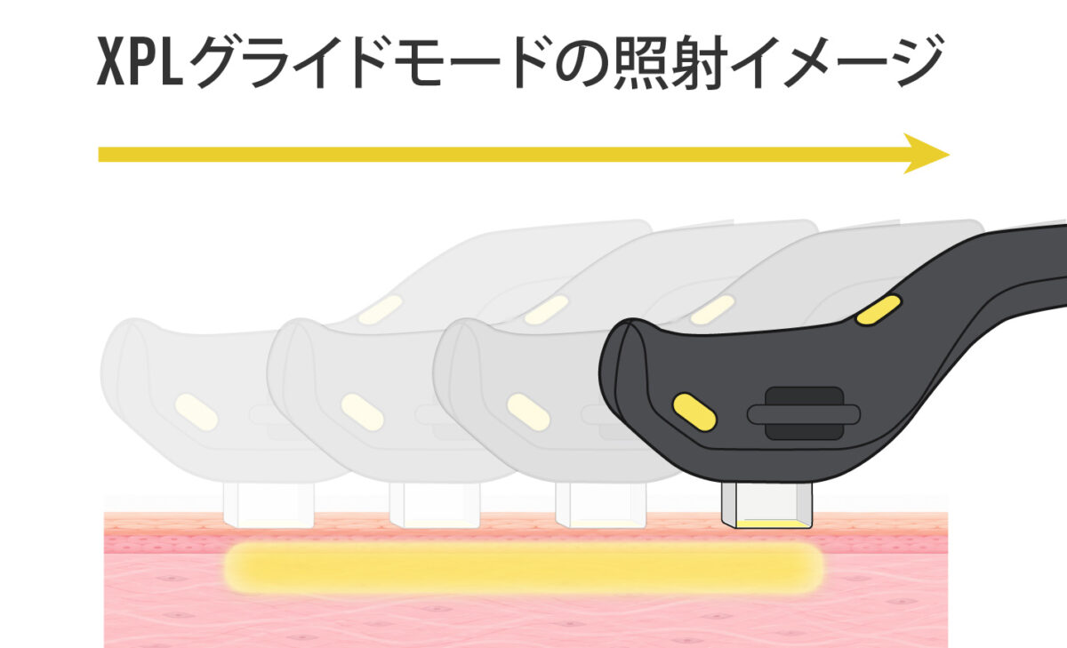 フォトフェイシャル ステラM22 XPL XPLグライドモードの照射イメージ