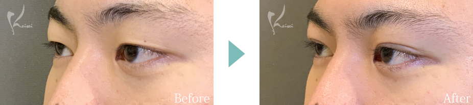 二重　自然癒着法の症例画像