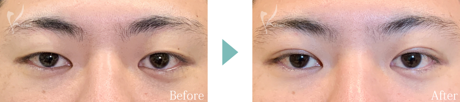 二重　自然癒着法の症例画像