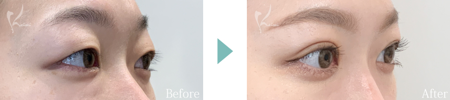 二重　自然癒着法の症例画像