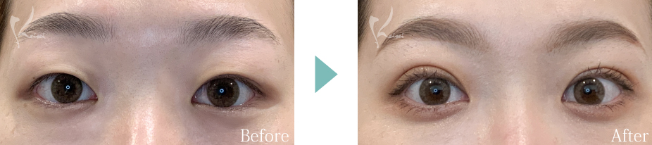 二重　自然癒着法の症例画像